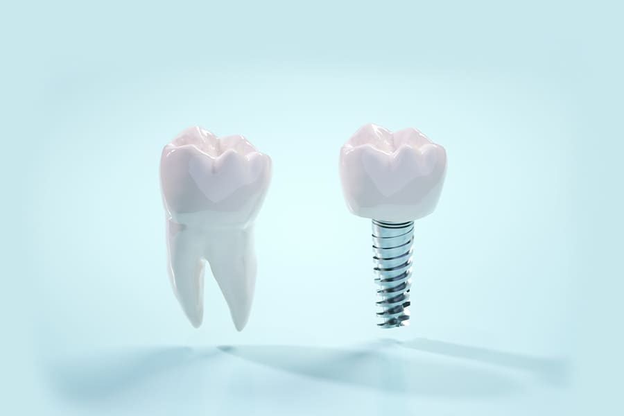 インプラントと天然の歯