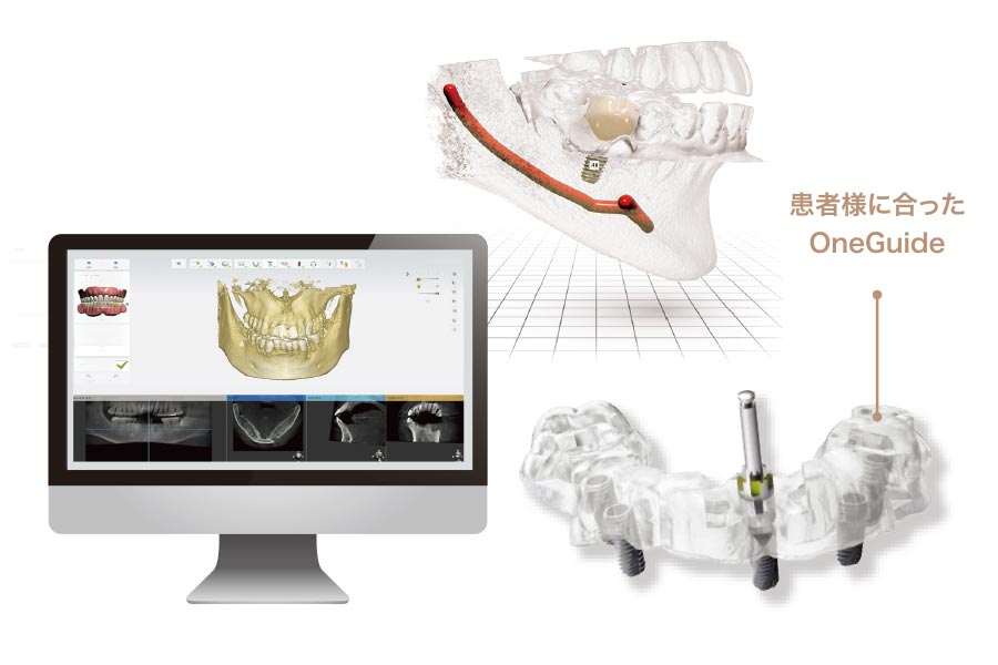 インプラント治療のCT、インプラントガイドの説明画像