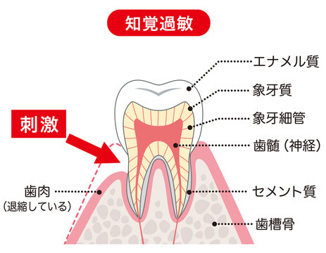 知覚過敏の歯の説明の図