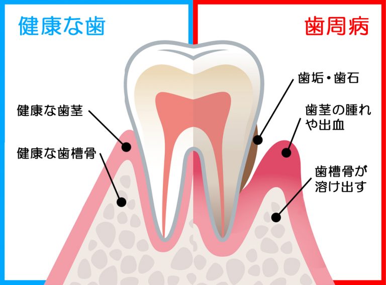 健康な歯と歯周病（歯槽膿漏）の歯との比較