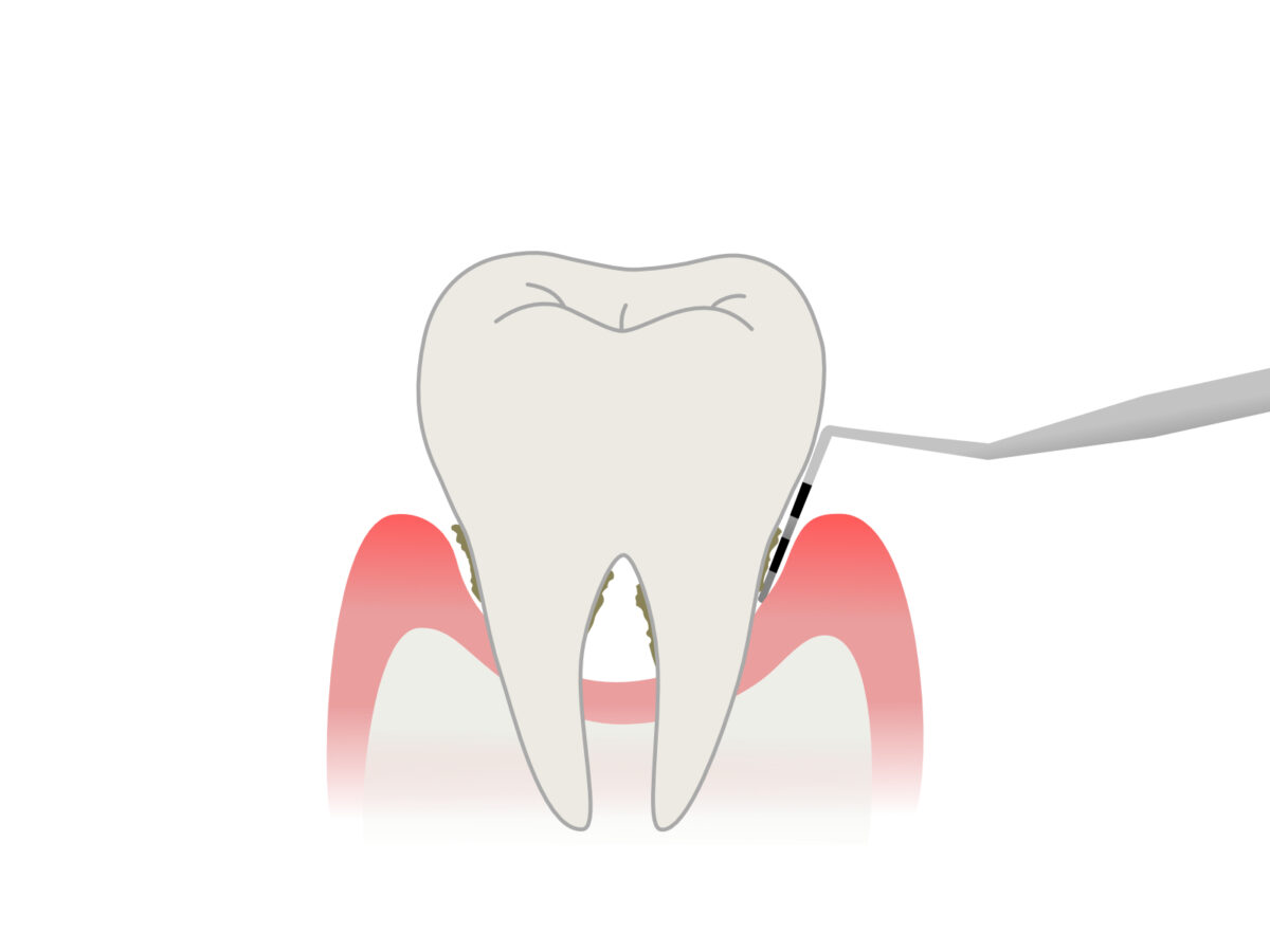 歯周病の検査であるプロービングの図