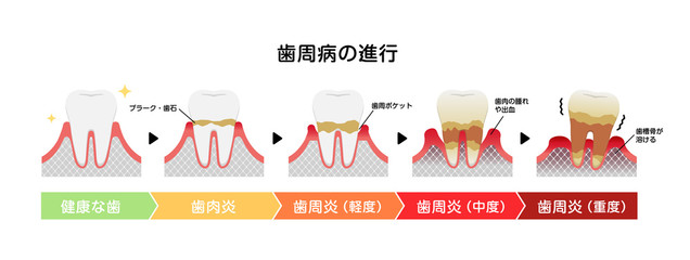 歯周病の進行の段階
