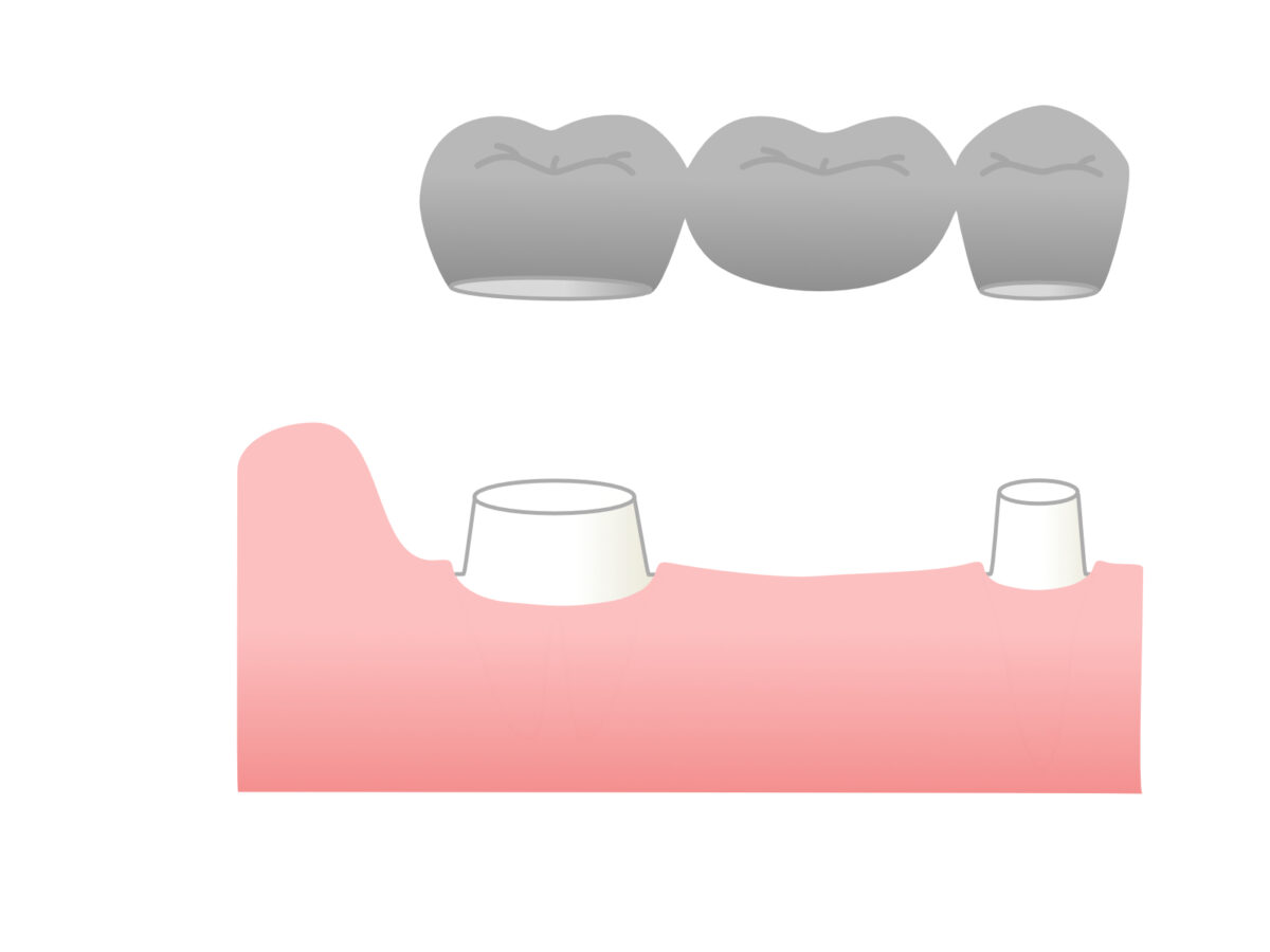 歯科治療のブリッジ治療のイラスト